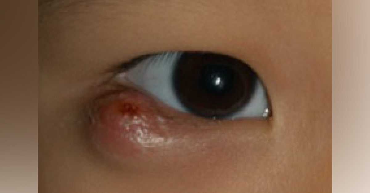Bump On The Right Lower Lid
