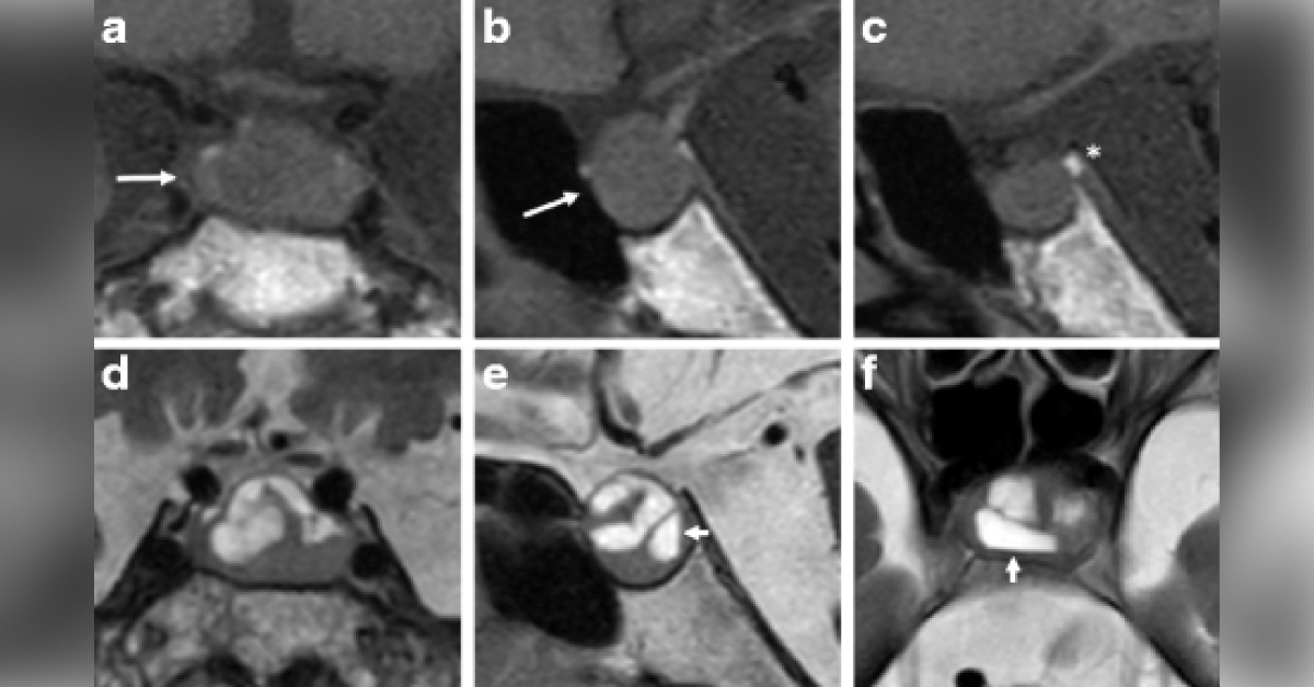 Pituitary Dysfunction In An Elderly Man