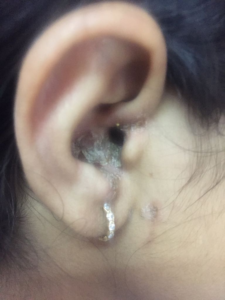 What Are These Skin Lesions?
