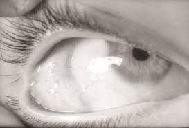 Ocular Manifestations Of Herpes Zoster Ophthalmicus