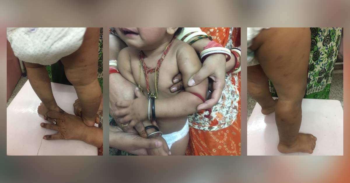 Is This Systemic Flared- Up Chickenpox Infection Or Something Else?