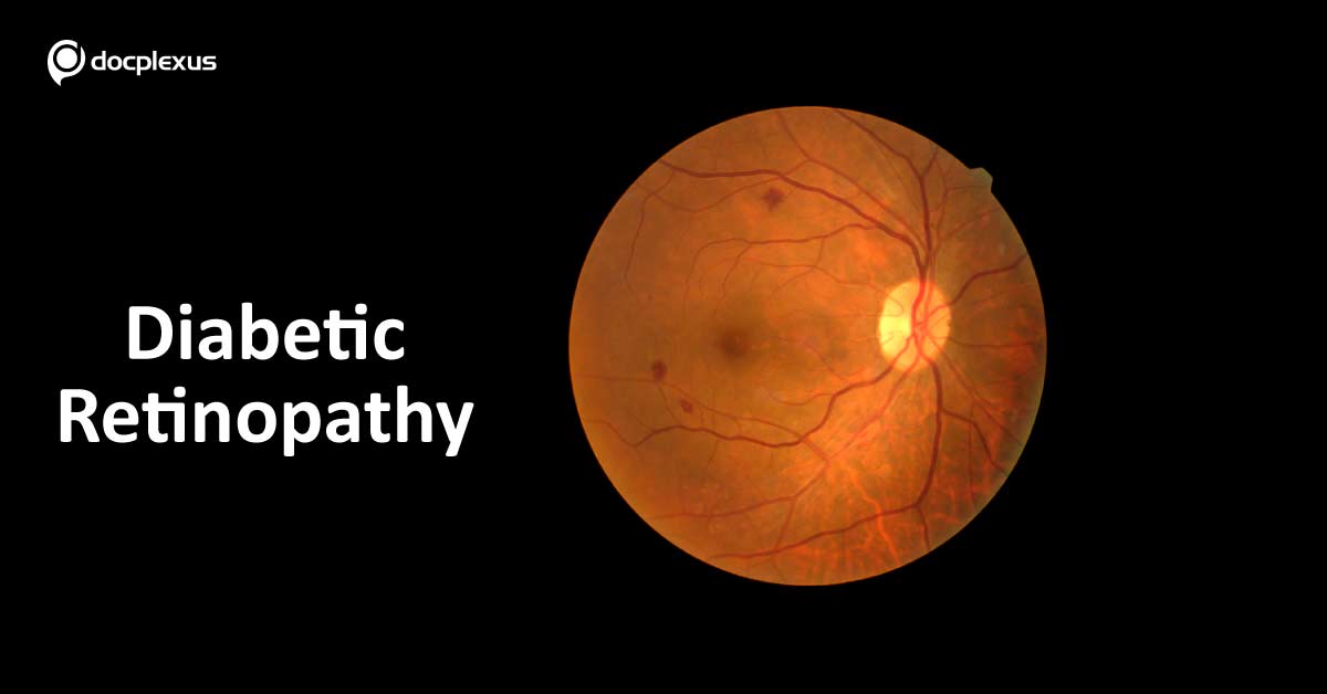 New Molecule For Treating Diabetic Retinopathy