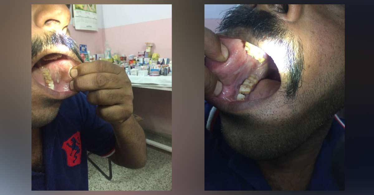 Oral Lesion In Pan Masala Chewer Man, Diagnosis? 