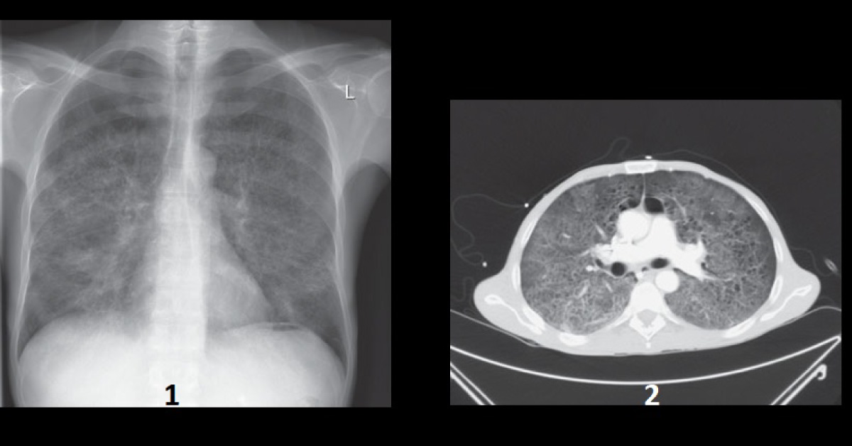 Why Does This HIV Patient Have Shortness Of Breath?