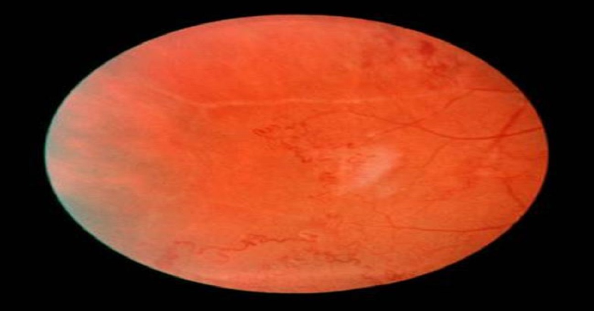 Eales Disease: Common In Young Healthy Individuals