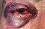 Brief Review Of Ocular Manifestation Of Blunt Trauma