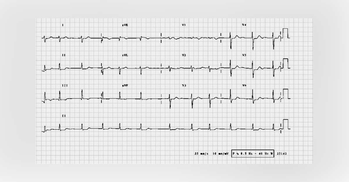 Interpret This ECG