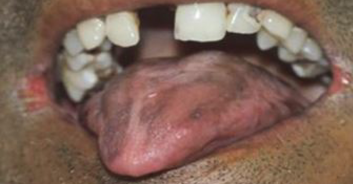 Mobile Lower Front Teeth