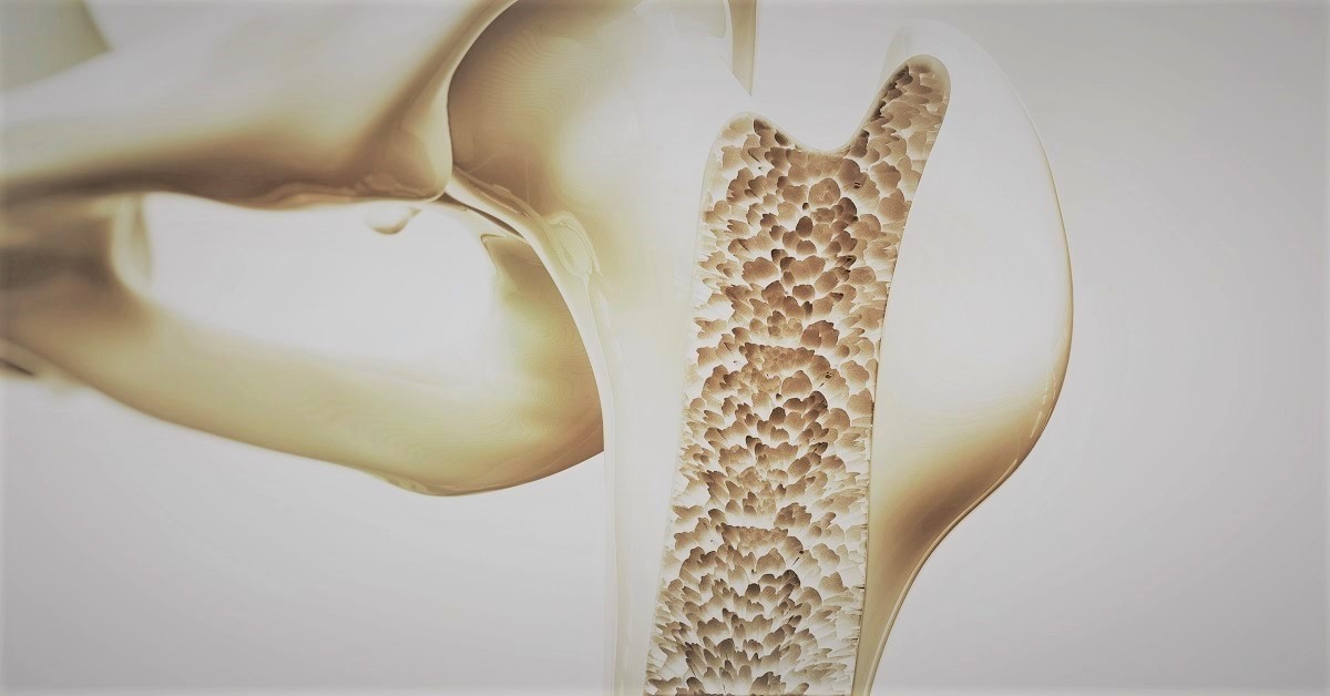 World Osteoporosis Day, Important Considerations For Choice of Treatment Modalities