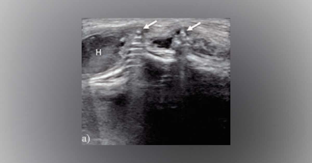 Soft Tissue Swelling In The Upper Thigh