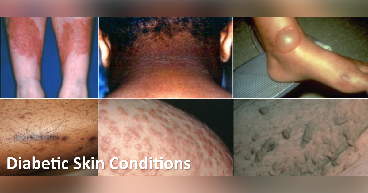 7 Vital Skin Manifestations In Diabetes