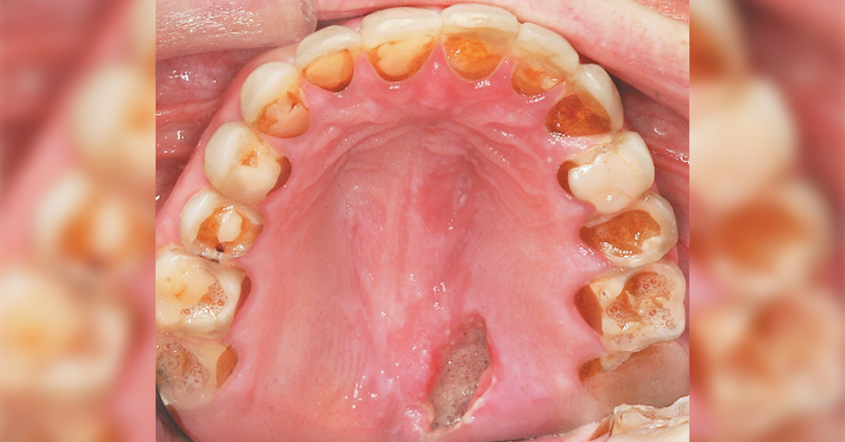 Identify This Disorder In A Young Woman