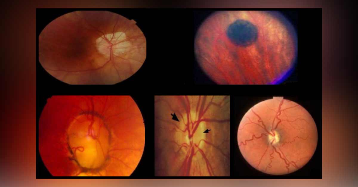 Leukaemic Involvement Of Various Ocular Tissues