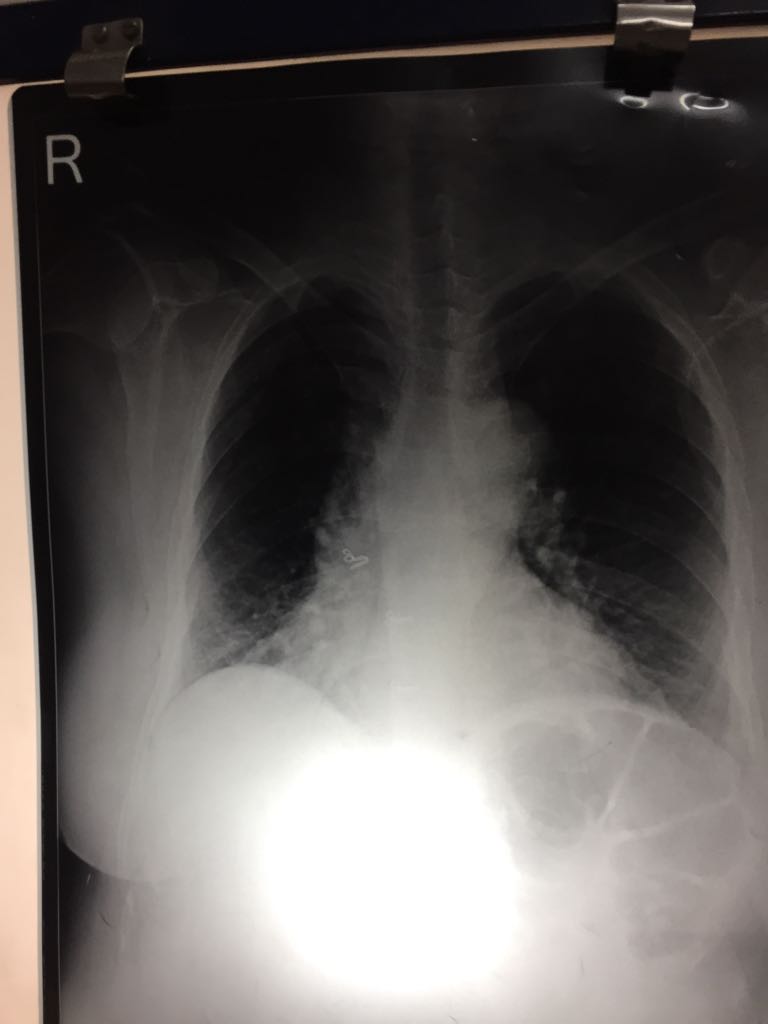 What Is On Rt Side Of Cardiac Shadow
