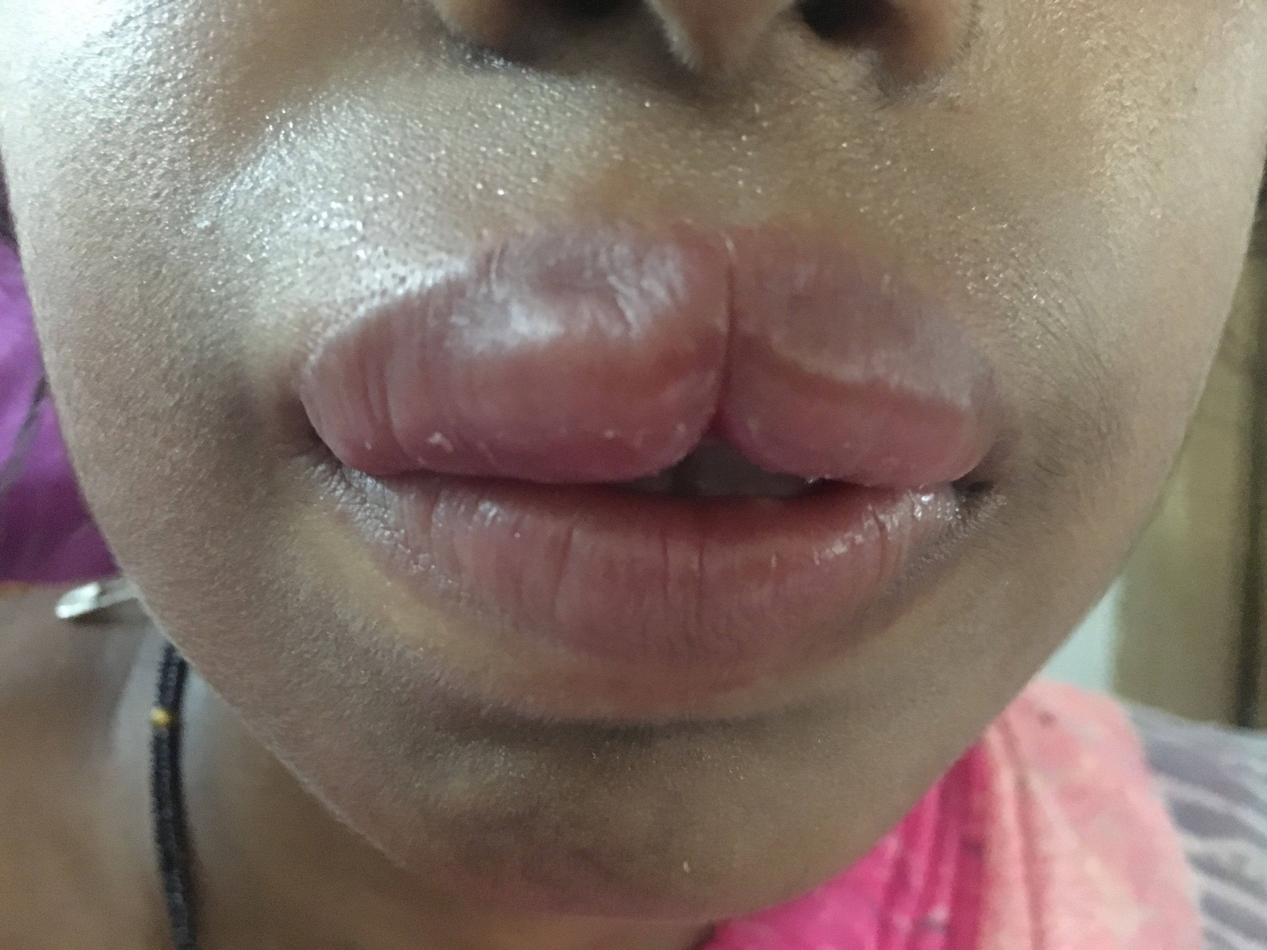 Patient Attended To Op With Swelling Of Both Lips