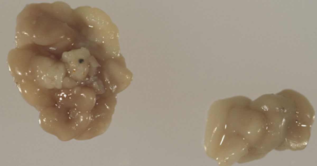 This Girl Is Coughing Up Bizarre Bodies
