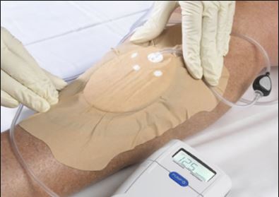 Managing Risks Associated With Negative Pressure Wound Therapy