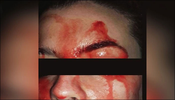 Condition Causes Woman To Sweat Blood, Leaves Doctors Perplexed