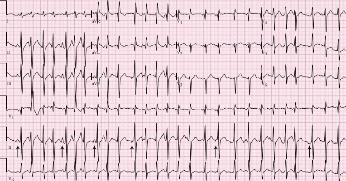 Conclude This ECG