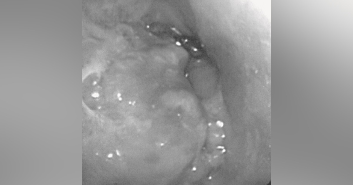 Manage This Patient With Epigastric Discomfort