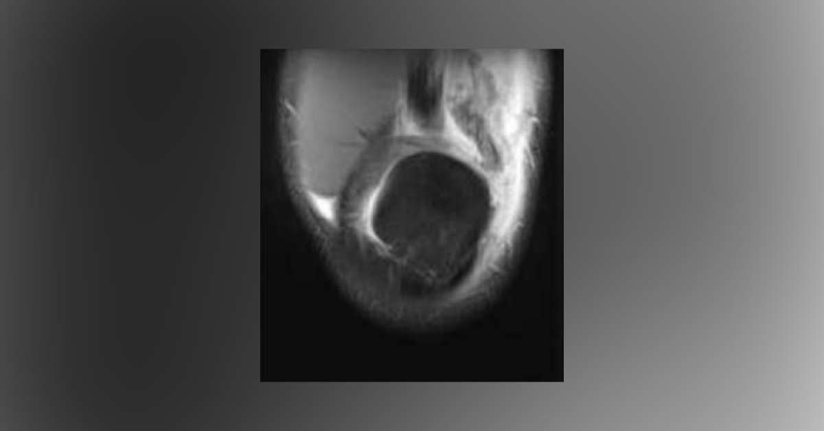 Left Knee Pain In An Athlete
