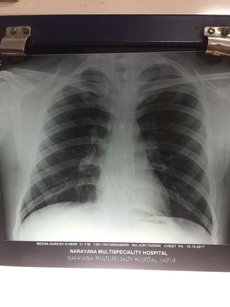 Is There Any Pathology At Rt Hilar Region