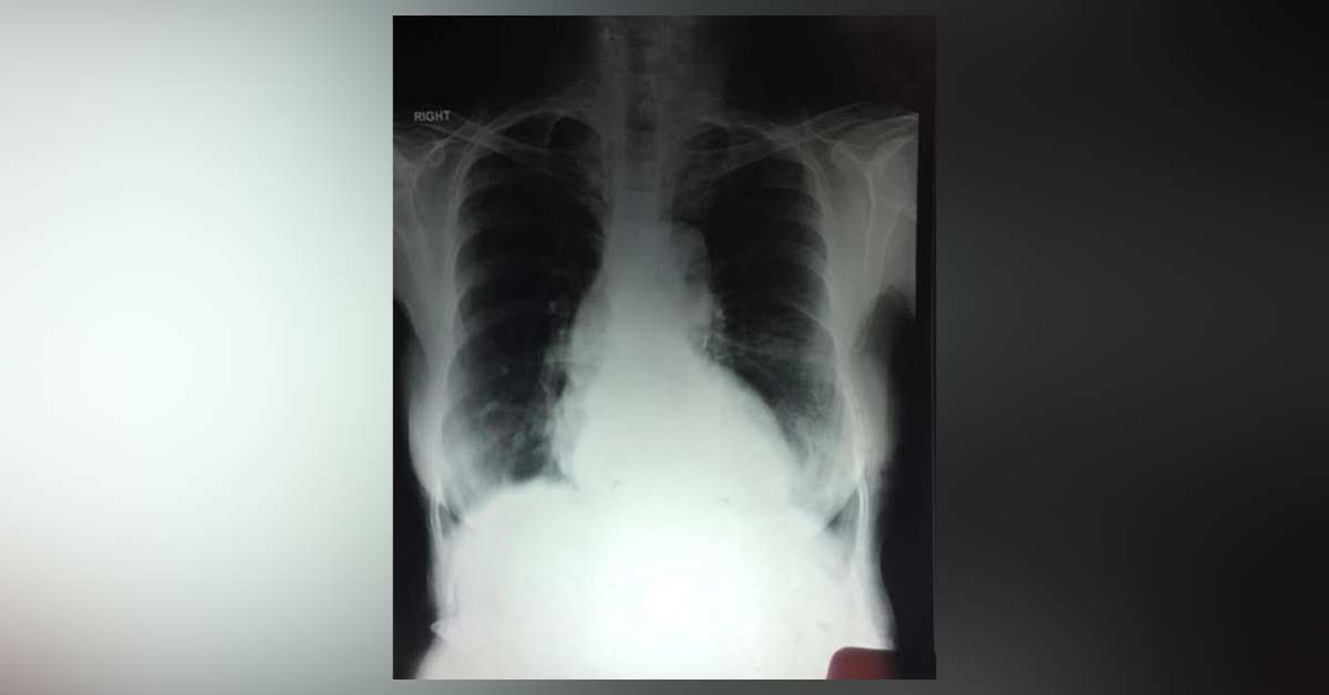 Why Is This Double Contour Of Rt Cardiac Border? 