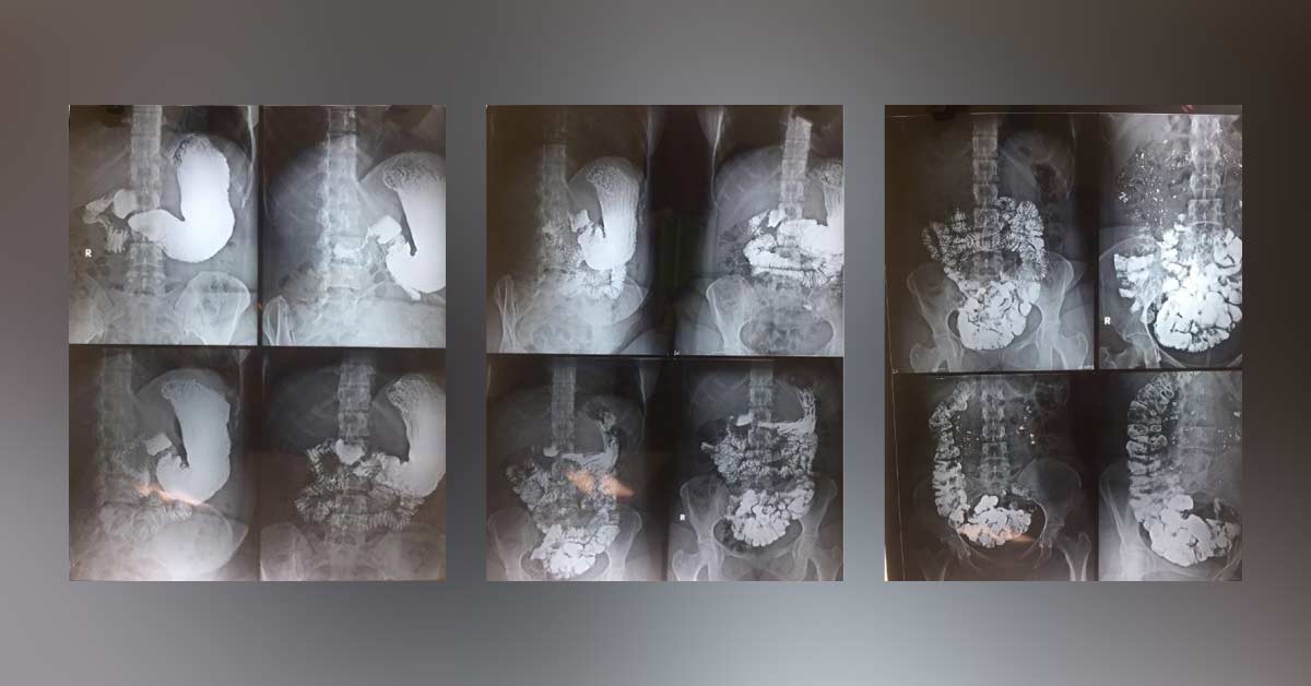 Any Pathology Can Be Suspected In Colonic Pictures?