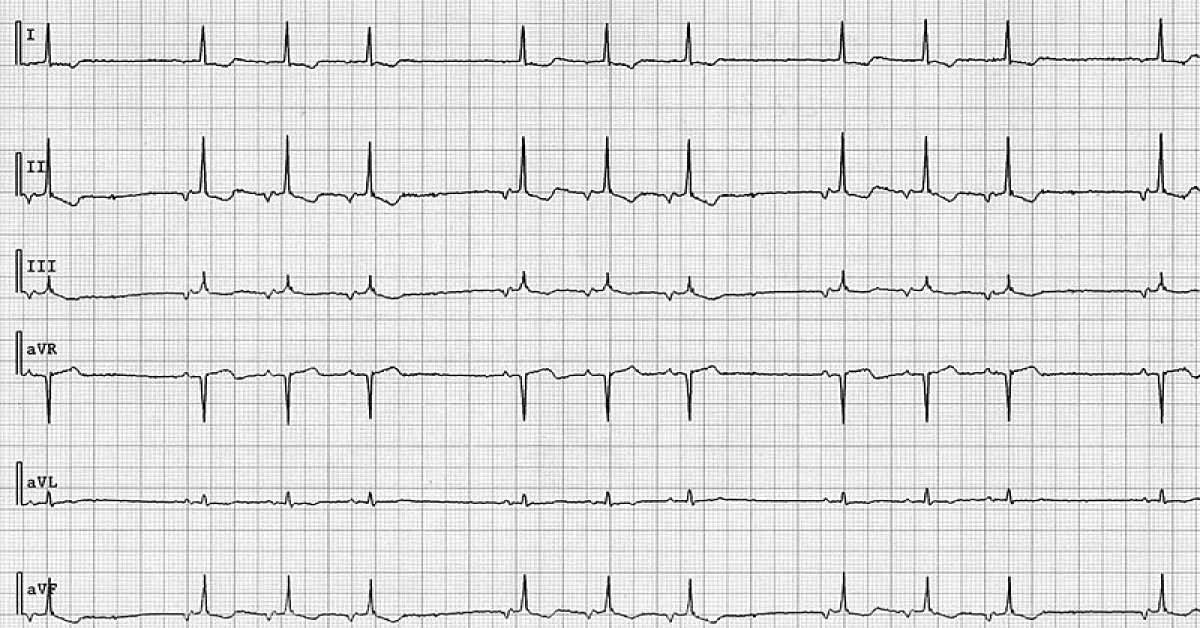 Identify This Cardiovascular Disease