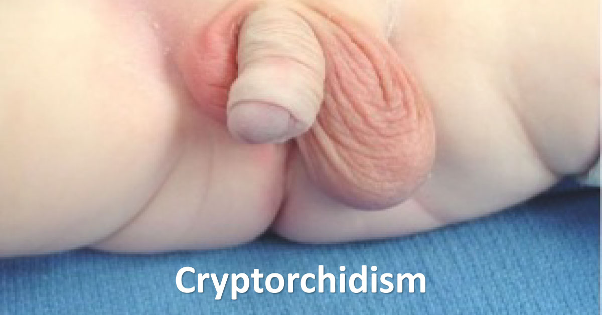 Management Of Cryptorchidism, A Congenital Anomaly