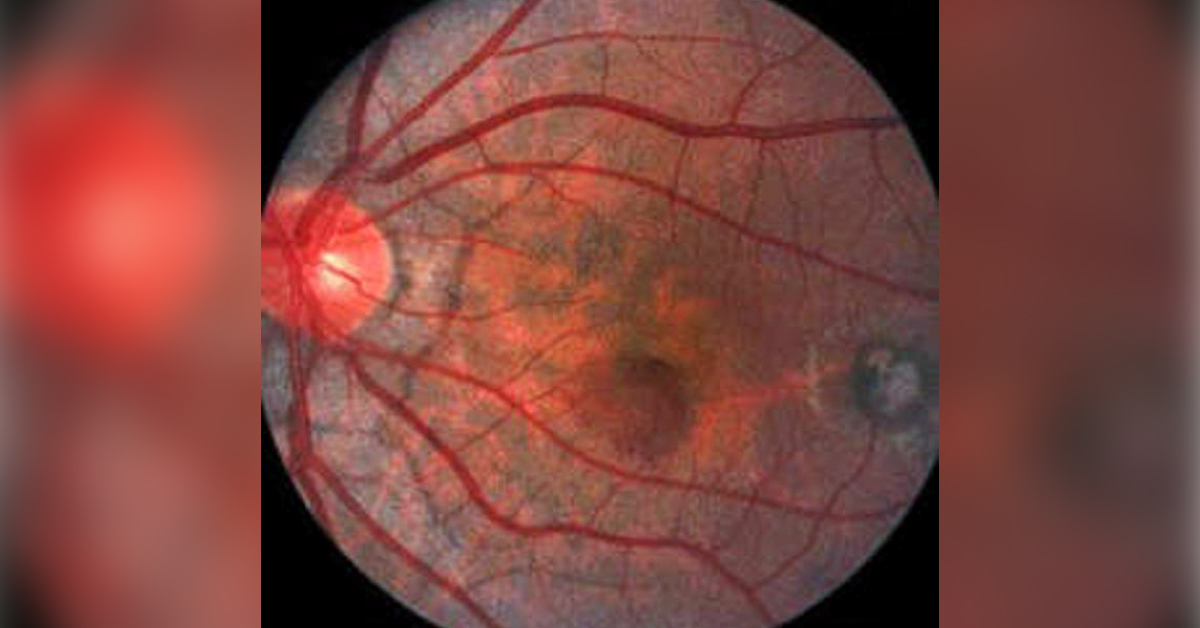 Recent Advances And Blood Supply To Optic Nerve Head
