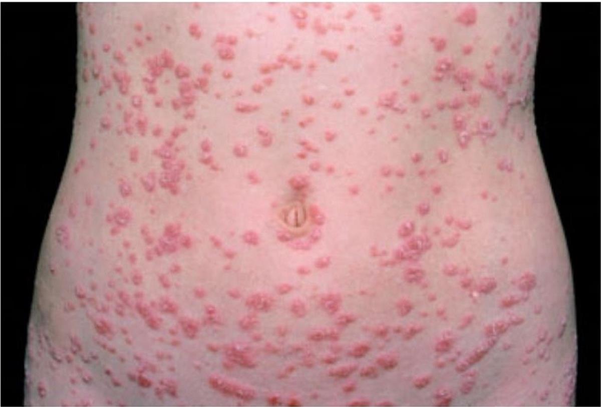 Rash After Sore Throat