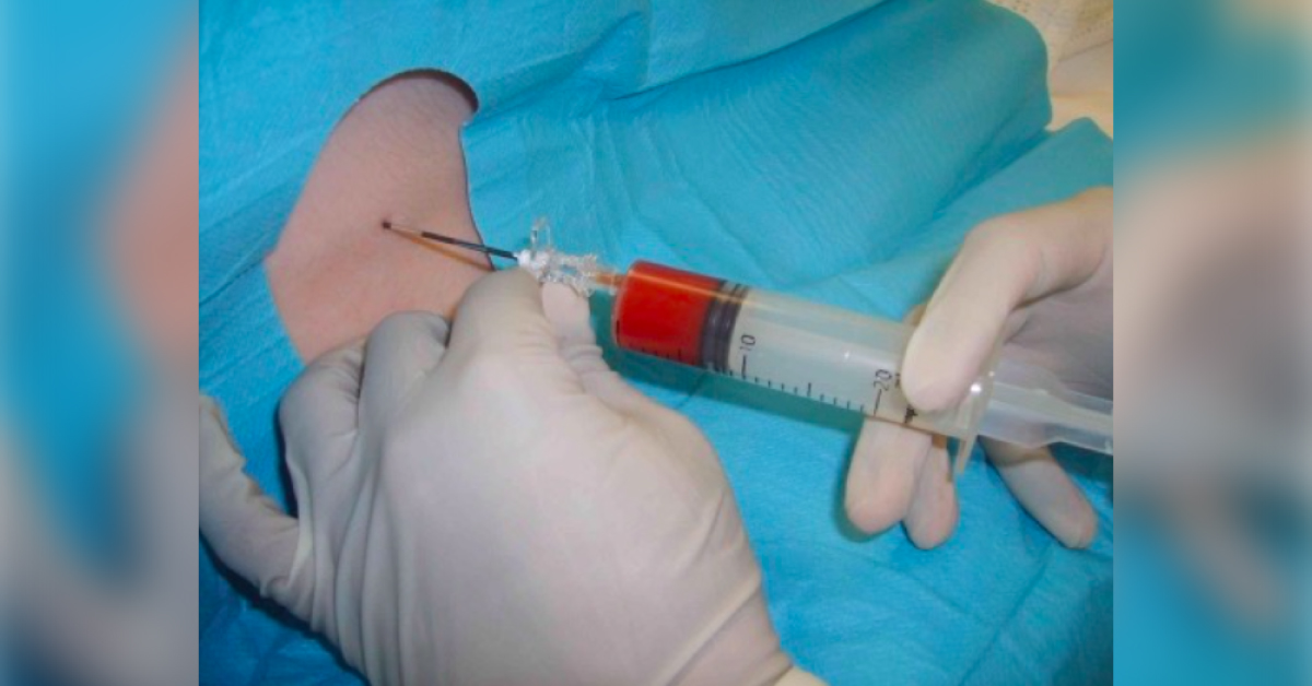 Postdural Puncture Headache, An Insight