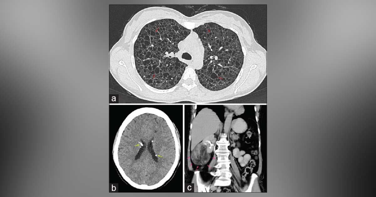 Diagnosis For Progressive Dyspnea