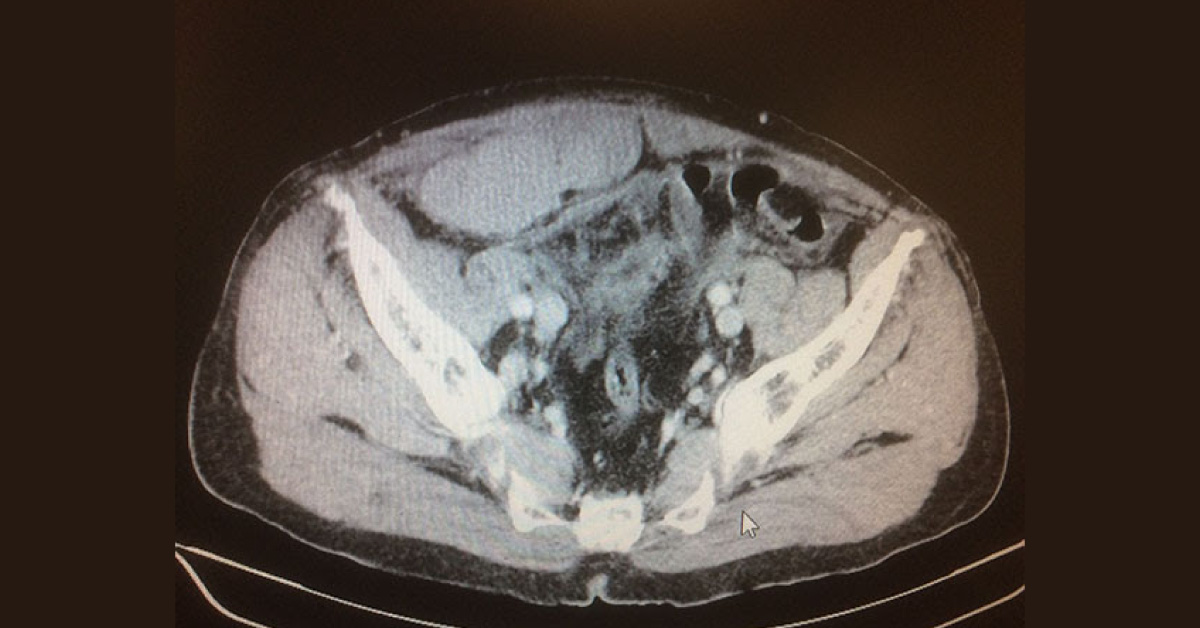 Sudden Pain In Cardiac Patient