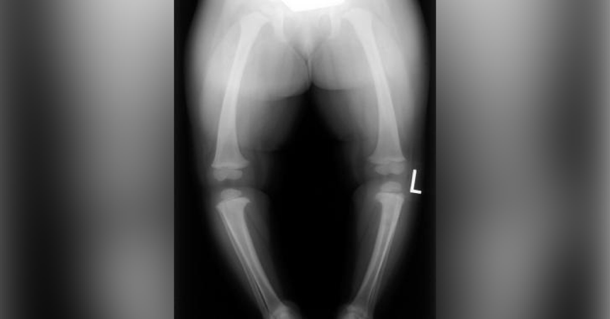 A Case Of Blounts Disease
