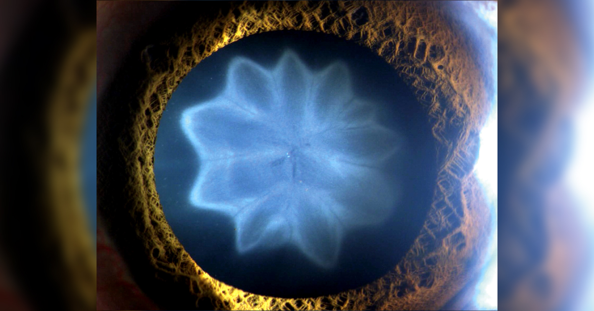 Identify This Ophthalmic Condition In A Young Man