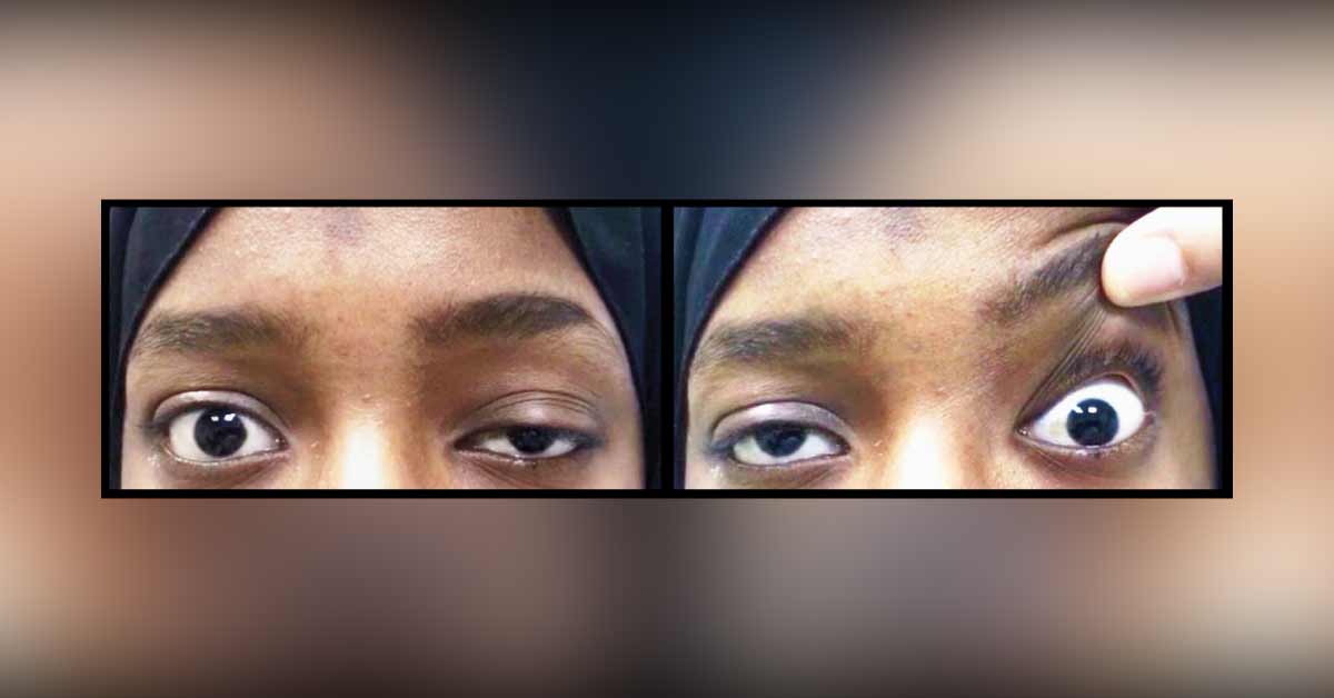 Identify This Neuromuscular Condition
