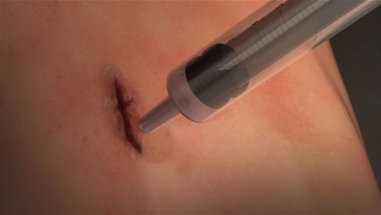 'Squirtable' Elastic Surgical Glue Seals Wounds In 60 Seconds
