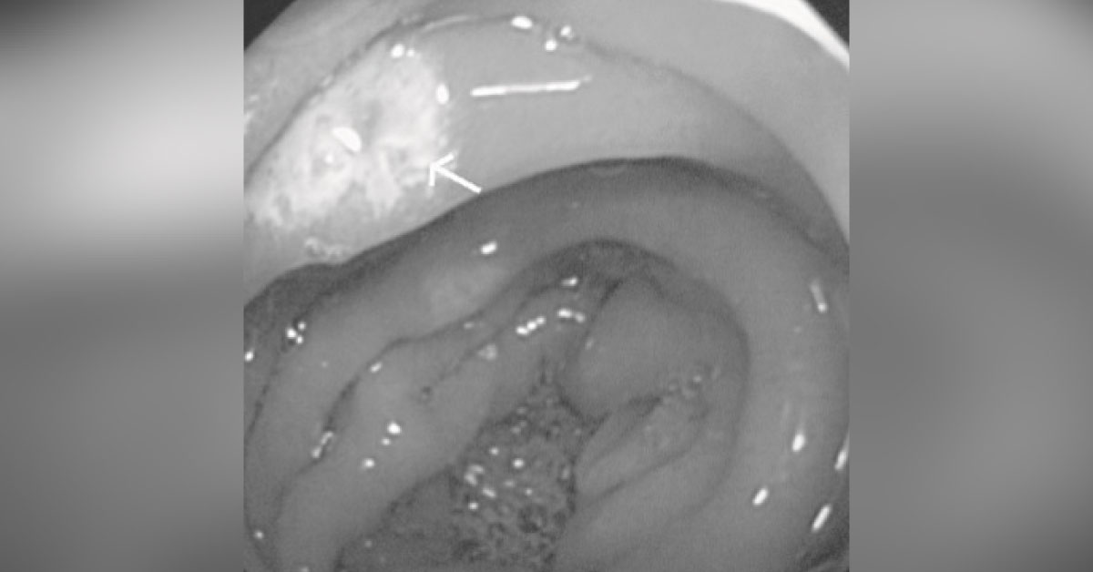 A Case Of Post-Prandial Pain