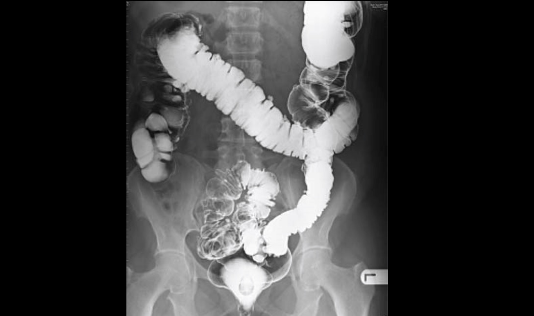 Solve This Case Of Abdominal Pain In This Elderly Woman