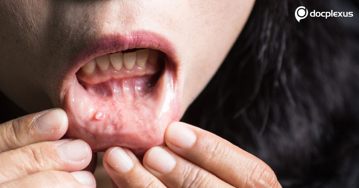 Resolve This Case Of Mucosal Candidiasis