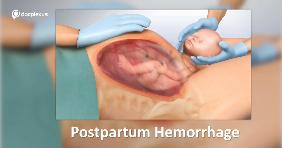 Anesthetic Evaluation Of Obstetric Hemorrhage