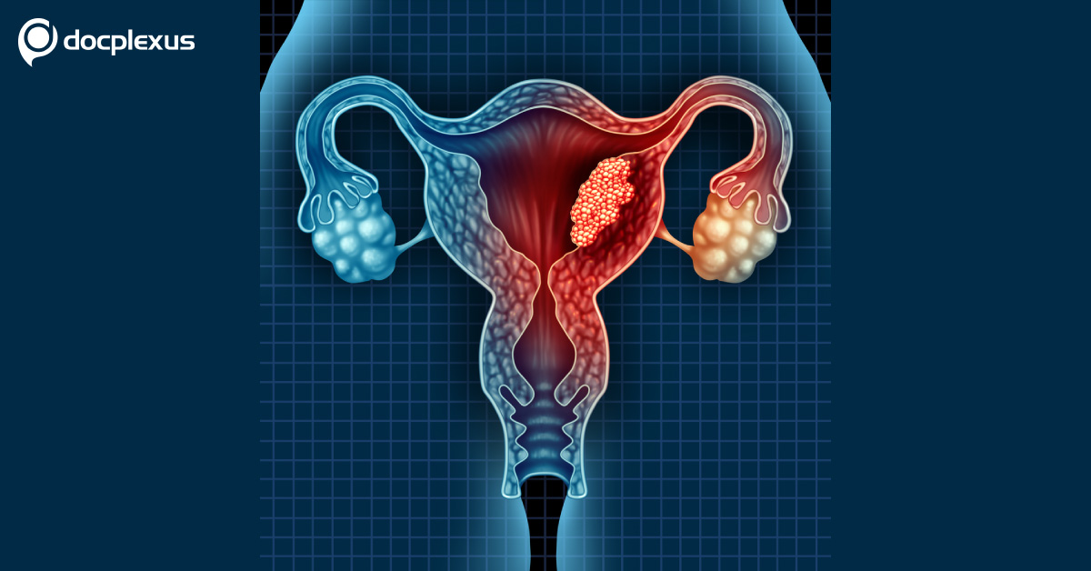 Endometrial Cancer: ESMO Guidelines for Diagnosis and Treatment