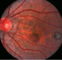 A Brief Review Of Congenital Retinopathy