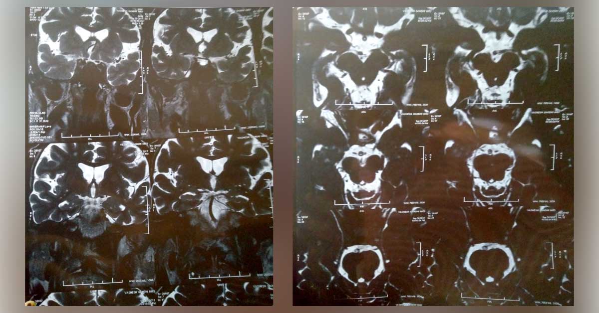 A Case Of Trigeminal Neuralgia