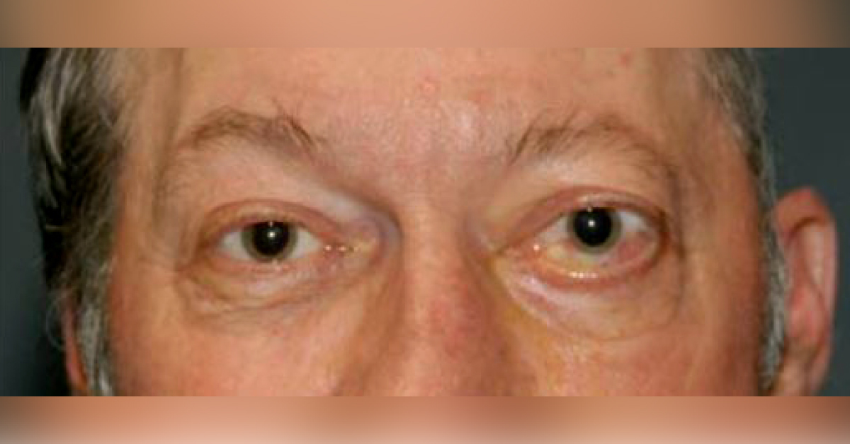 Reason For Impaired Vision In Old Man