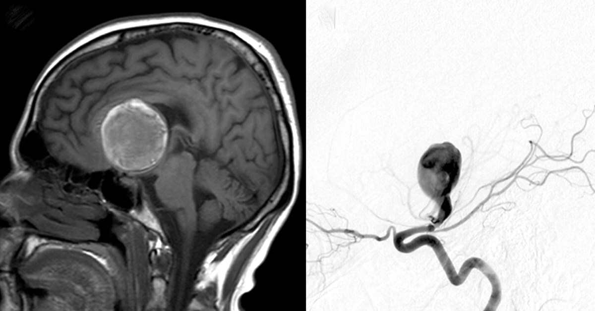 Unruptured Intracranial Aneurysms Management