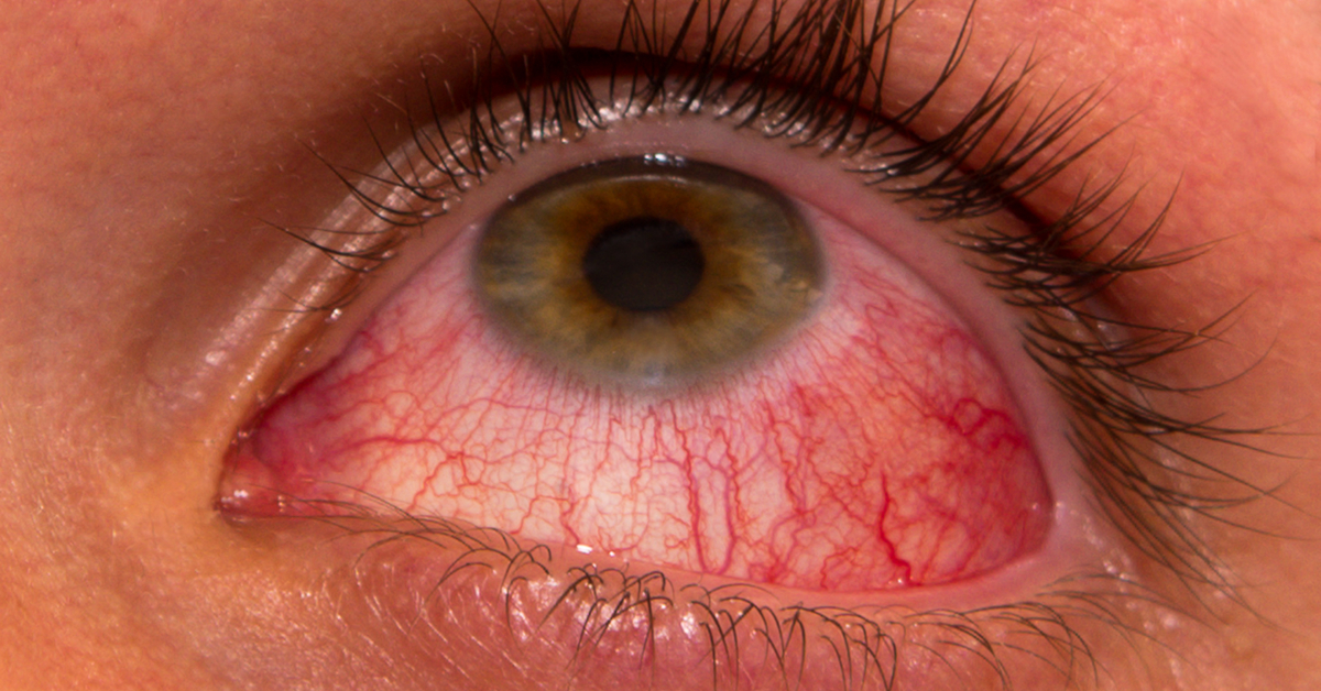 Classification Of Uveitis A Review