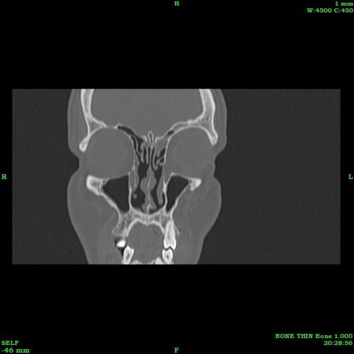 A Case Of Frontal Sinusitis